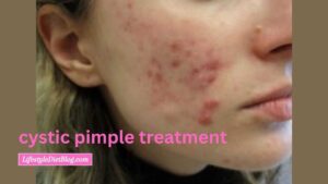 Cystic Acne: What Is It, Symptoms, Causes and Treatment